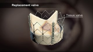 TAVI Transcatheter Aortic Valve Implantation [upl. by Afirahs]