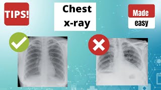 Chest x ray  How to read a Chest x ray TIPS [upl. by Sparke]