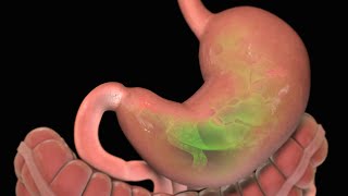 Stomach Ulcer  Nucleus Health [upl. by Delos]