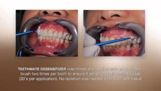 Desensitizing Procedure using the NEW TEETHMATE DESENSITIZER from Kuraray [upl. by Telfore]