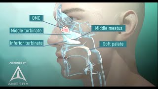 Adenoid Cystic Carcinoma sphenoid sinus [upl. by Karry]