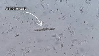 Urine analysis granular cast amp transitional epithelial cells [upl. by Cirala]