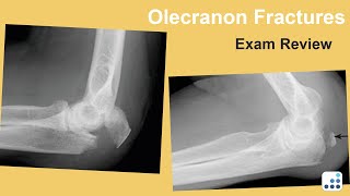 Olecranon Fractures  Joaquin SanchezSotelo MD [upl. by Towland]