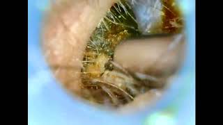 Satisfying Ear Wax Removal Compilation 1 [upl. by Boucher]