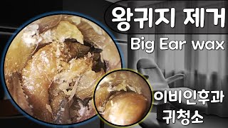 귀팡 왕귀지 청소 Big Ear wax removal 초고화질 HD endoscope [upl. by Baerman661]