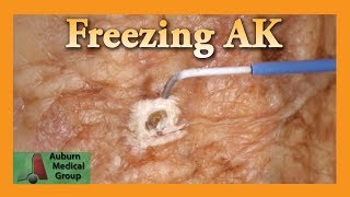 Freezing Hand Actinic Keratosis with Liquid Nitrogen  Auburn Medical Group [upl. by Uy]