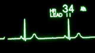 Sinus Bradycardia [upl. by Marteena]