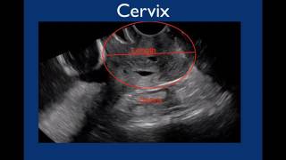 Pelvic Ultrasound [upl. by Garrett]