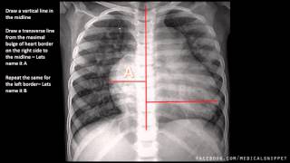 How to measure Cardiomegaly in CXR [upl. by Ardek]