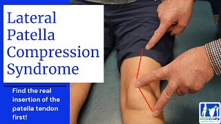 Lateral Patella Compression Syndrome LPCS [upl. by Bomke]