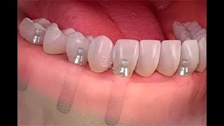 Zirconia Dental Implants Compared to Titanium Dental Implants [upl. by Ensoll]