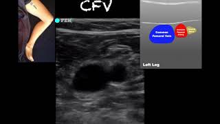 POCUS  Lower Extremity Deep Venous Thrombosis DVT  Updated [upl. by Mountford]