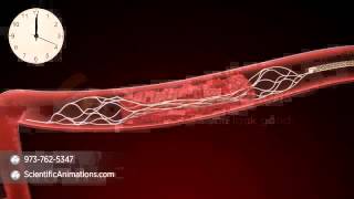 Deep Vein Thrombosis Treatment With Trellis Procedure  NYC Surgical Associates [upl. by Donica701]