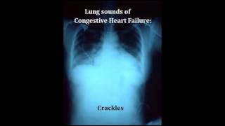 lung sounds  crackles [upl. by Nasah]