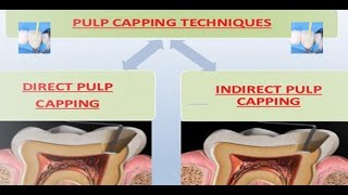 PULP CAPPING Procedure and pulp capping a case report [upl. by Iznyl]