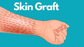 Skin Graft Healing And After Care [upl. by Nitneuq342]