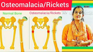 Osteomalacia amp Rickets  Cause Symptom Treatment Diagnosis MedicalSurgical amp Nursing Management [upl. by Neelram741]