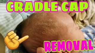 SUPER EASY AND NATURAL WAY TO REMOVE CRADLE CAP [upl. by Narak]