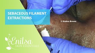 Sebaceous Filament Extractions [upl. by Zeni]