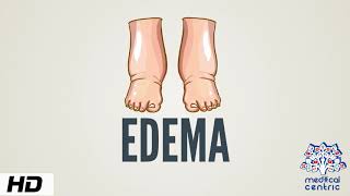 Edema Causes Signs and Symptoms Diagnosis and Treatment [upl. by Solley]