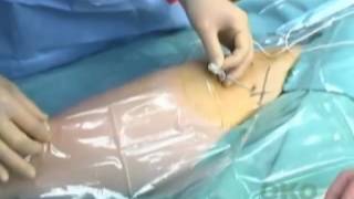 Continuous Femoral Nerve Block [upl. by Jackqueline]