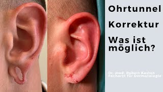 Flesh tunnel zunähen ear lobe reconstruction Fallbeispiel [upl. by Artemed420]