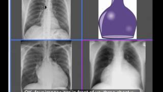 Chest xray  Cardiomegaly or No Cardiomegaly  water bottle sign [upl. by Eissirhc403]