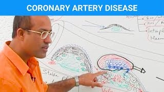 Coronary Artery Disease  Ischemic Heart Disease  Angina🫀 [upl. by Micheal]