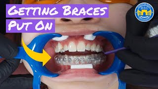 Process of Getting Braces [upl. by Ilrebmik]