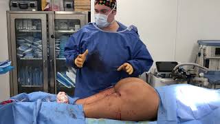 Massive Silicone Injection Removal From Butt with Dr Kenneth Hughes Los Angeles Plastic Surgeon [upl. by Addi]