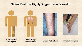 VASCULITIS  VASCULAR PATHOLOGY  Recap [upl. by Alanson]