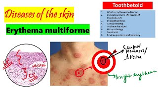 Erythema Multiforme  Etiology Clinical features Histopathology treatment [upl. by Oman]