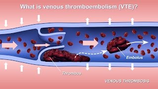 Mechanical Thrombectomy  Neurovascular stent deployment [upl. by Aelsel]