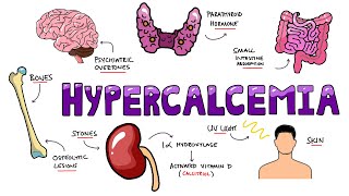 An Approach to Hypercalcemia  Causes Calcium Homeostasis Mechanisms amp Signs and Symptoms Mnemonic [upl. by Nelan]