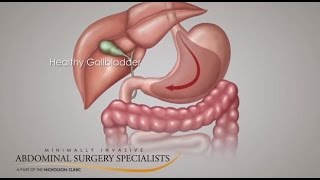 Gallbladder Symptoms [upl. by Eceinej]