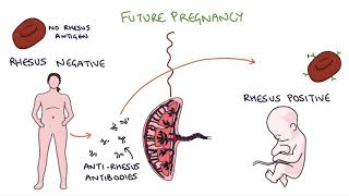 Understanding Rhesus Status and AntiD in Pregnancy [upl. by Alemahs761]