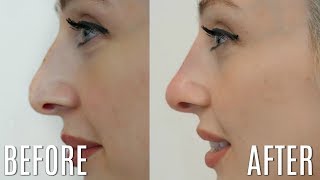 5 Minute Nose Job  Nonsurgical Rhinoplasty  Carly Musleh [upl. by Alric233]