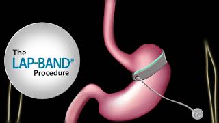 Fast Facts about The LAPBAND® procedure [upl. by Llednol670]