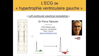 7a L’ECG de lhypertrophie ventriculaire gauche HVG Basic Dr Taboulet [upl. by Ob]