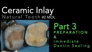 Lithium Disilicate Ceramics Part 3 Preparation and Immediate Dentin Sealing IDS [upl. by Annoyik470]