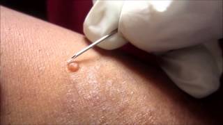 Removing H P Body From Molluscum Contagiosum [upl. by Neerak370]