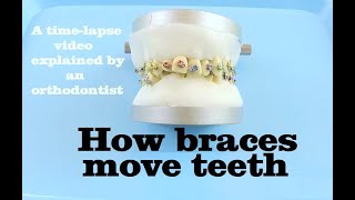 How braces move teeth timelapse  Braces Explained [upl. by Galliett14]