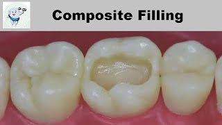 Composite Dental Filling Step by Step [upl. by Okimik]