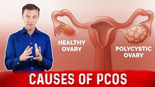 Do all Ovarian cysts need surgery or treatmentDr Sanjay Panicker [upl. by Ogaitnas10]