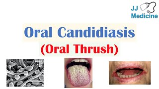 Oral Candidiasis Oral Thrush  Causes Pathophysiology Signs amp Symptoms Diagnosis Treatment [upl. by Reahard]