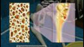 Osteoporosis3D Medical Animation [upl. by Neerod]