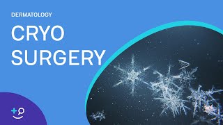 Cryo Surgery Procedure Freezing [upl. by Anilemrac]