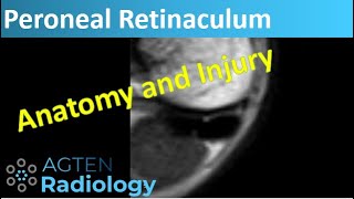 Superior Peroneal Retinaculum  MRI Anatomy and Injuries [upl. by Nylevol]