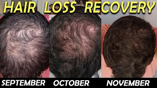 3 Month Hair Loss Reversal with Dutasteride Minoxidil and Saw Palmetto [upl. by Veriee]