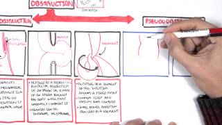 Bowel Obstruction  Causes and Pathophysiology [upl. by Eidnak]